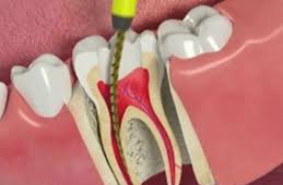 Root Canal Treatment