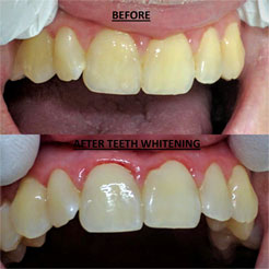 Teeth Whitening Services