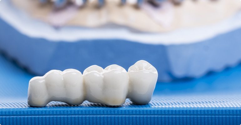 Dental Crown and Bridges CBV