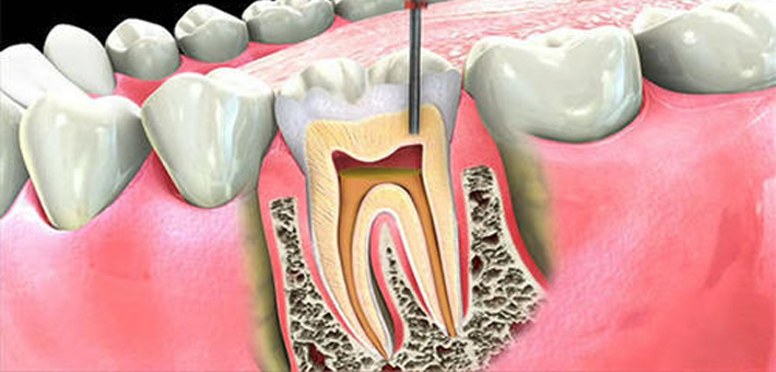 Root Canal Treatment